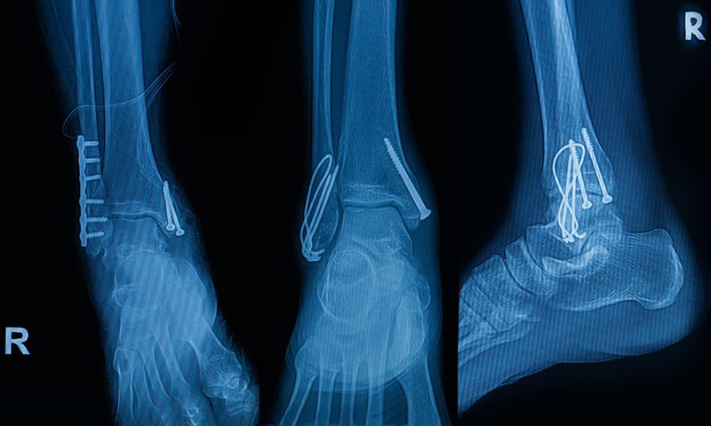 X-ray of a foot and ankle