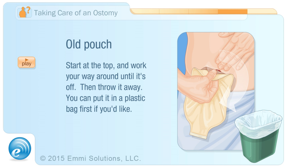 graphic of removing an ostomy bag