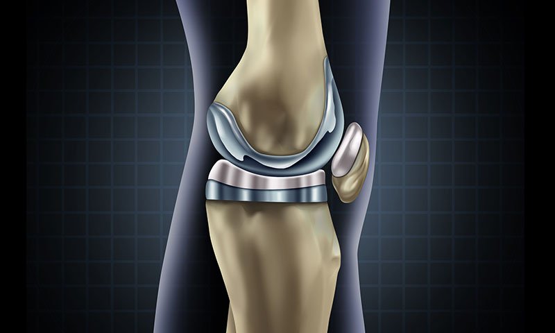 Illustration of an artificial knee