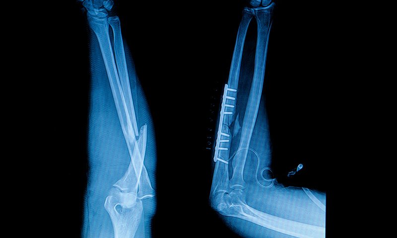 X-ray of an elbow