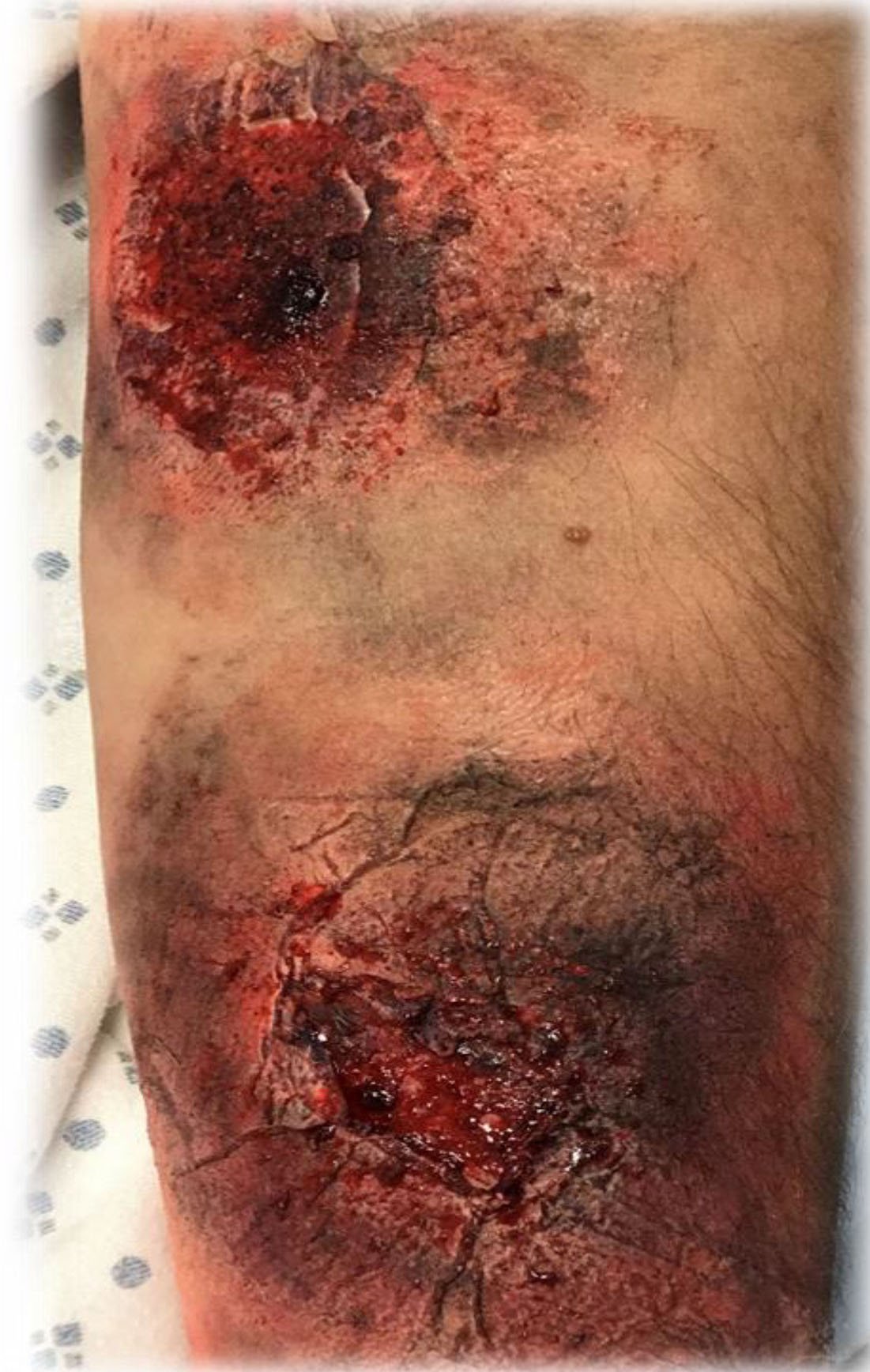 Moulage on arm