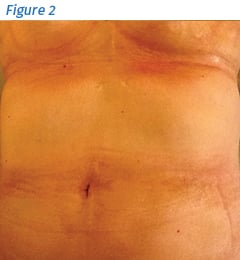 Generalized Morphea Trunk - Figure 2